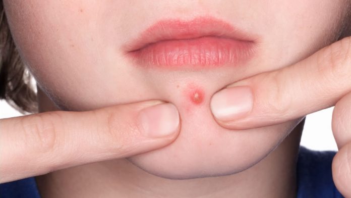 How to pop a pimple